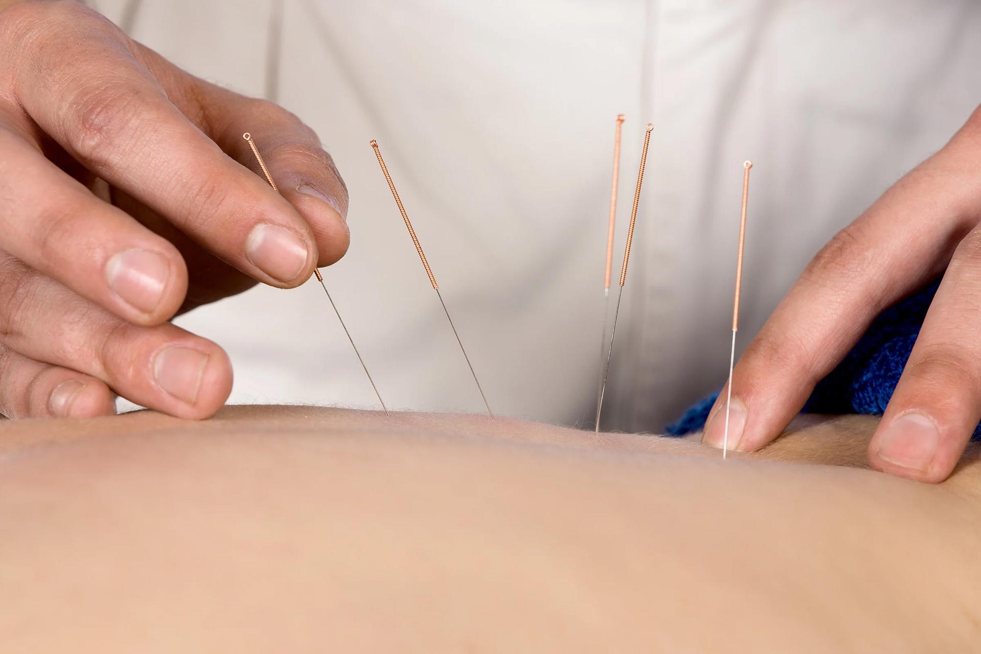 Dry Needling Service Hero Image