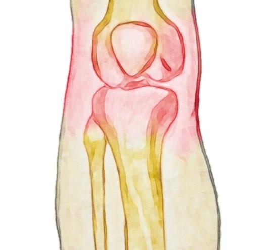 Can Physiotherapy Help Osteoarthritis?